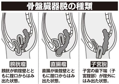 骨盤臓器脱に対する腟 内ペッサリー